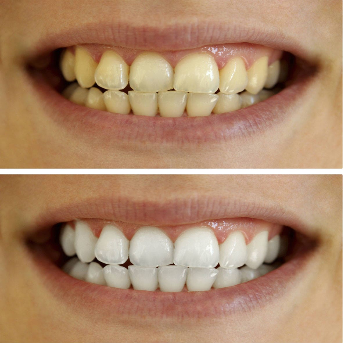 Misspone® Essential Care Toothpaste – 6 - in - 1 Whitening + Total Care
