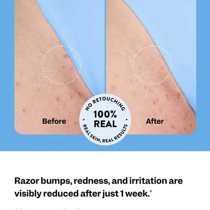 Smoothing Solution Ingrown Hair Treatment: Glide-On Roller with BHA + Cica + Niacinamide for Bump-Free, Baby-Soft Skin