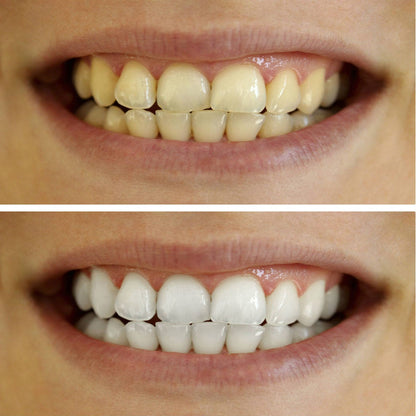 Misspone® Essential Care Toothpaste – 6 - in - 1 Whitening + Total Care